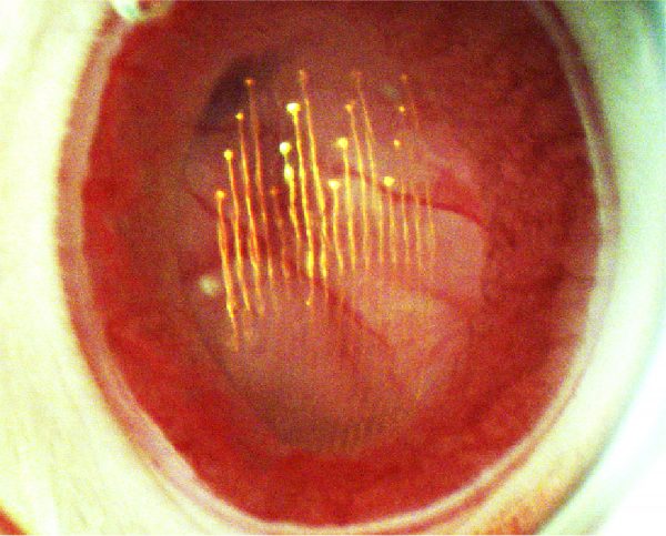 The interface between a mouse’s retina and a new injectable mesh device that records the activity of nerves inside the eye.