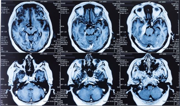 191029 Brain scan