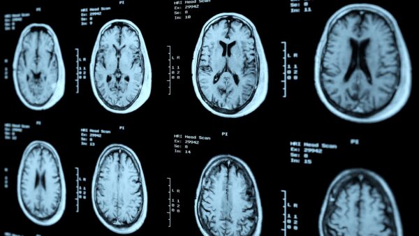 190904 brain scan cancer mri