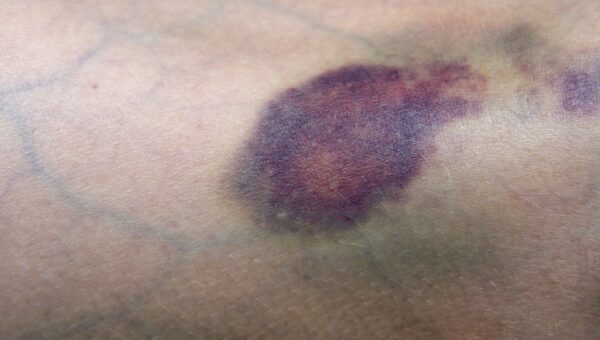 201107 Bruise 1