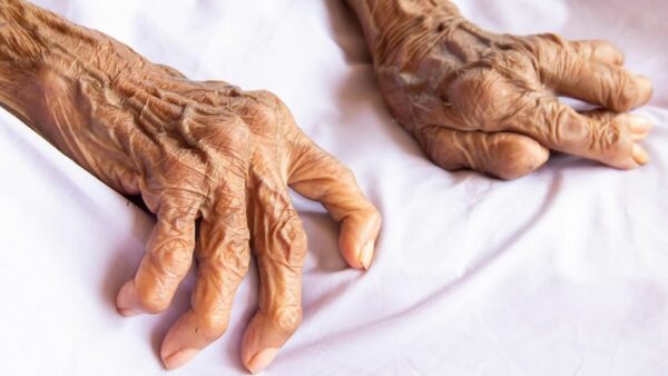 Rheumatoid arthritis in the hands. Credit witsawat sananrum Getty Images 1