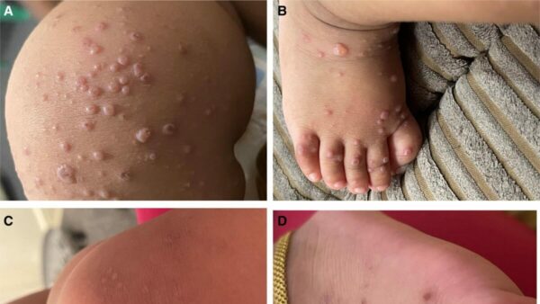Four pictures of lesions on a child's body. They are numerous and very raised and red.