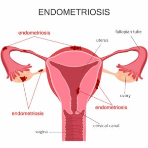 Uterus Endometriosis Diagram