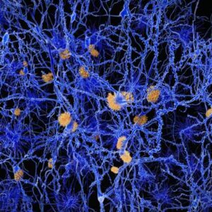 Alzheimer's disease - computer illustration of amyloid plaques amongst neurons