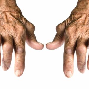 Rheumatoid arthritis symptoms in hands (swollen, deformed joints)