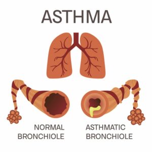 Bronchiole in asthma sufferers are clogged with mucus
