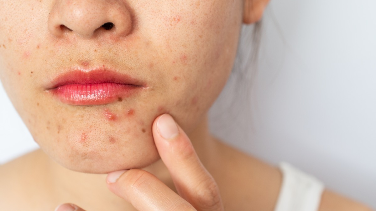 close up of person's chin with acne