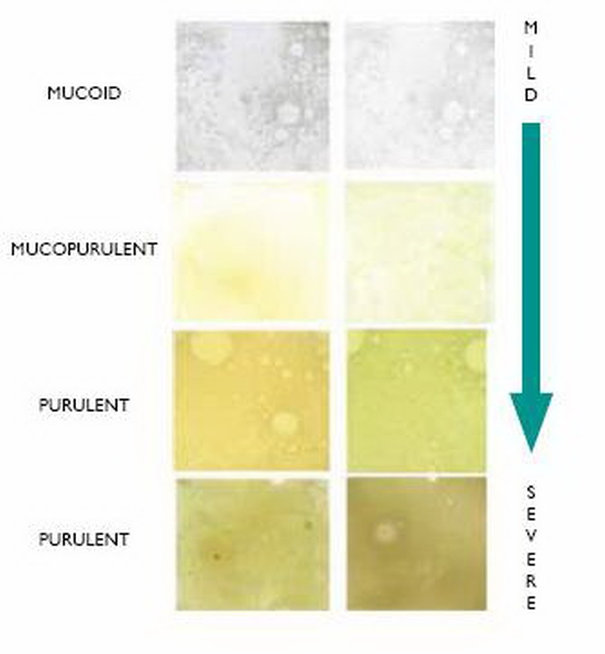 bronchiectasis severity is connected to the colour of phlegm 3 Phlegm colour chart